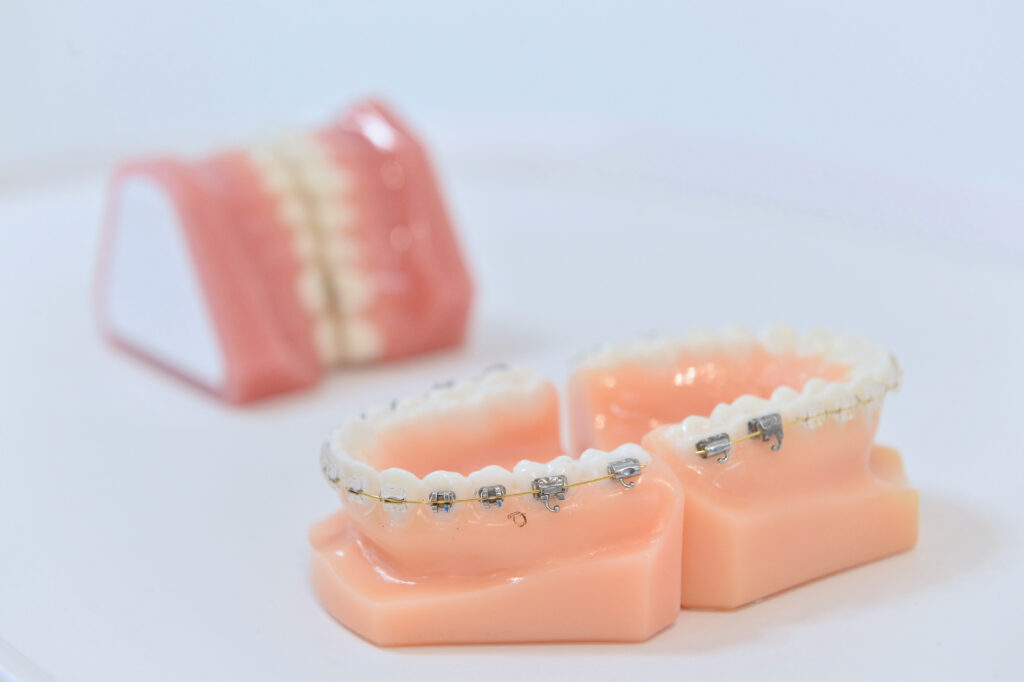 歯科矯正装置の種類と、それぞれの特徴について